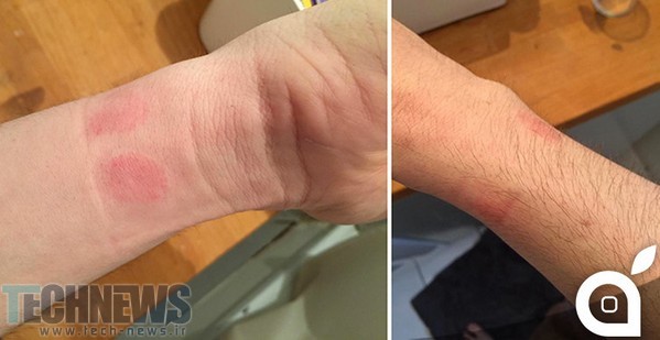 Some-Apple-Watch-wearers-are-experiencing-allergic-reactions-from-wearing-the-device-nbsp