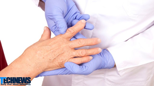 تشخیص قطعی بیماری آرتریت روماتوئید با اسکنرهای حرارتی