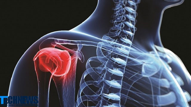 درمان سرطان استخوان با کمک فناوری نانو