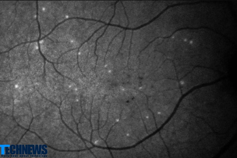 تشخیص سریع بیماری آب سیاه چشم با هوش مصنوعی