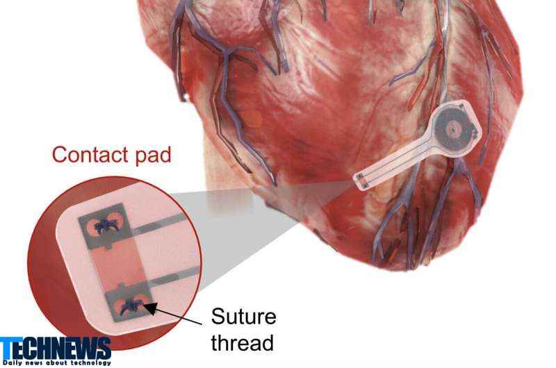 ساخت ضربان ساز قلب بی سیم بدون نیاز به باتری و با قابلیت جذب در بدن