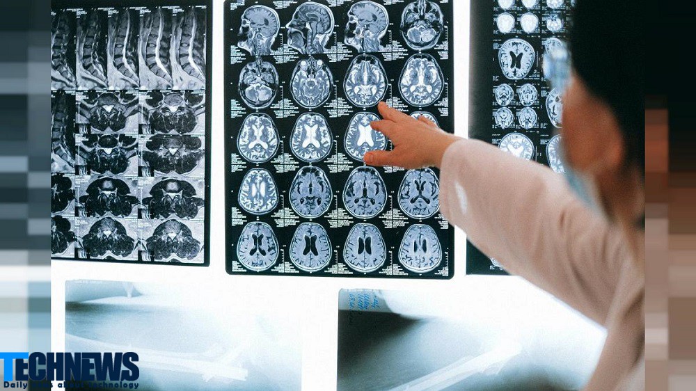 دقت بالای روش مبتنی بر هوش مصنوعی در تشخیص زودهنگام آلزایمر