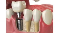 ایمپلنت دندان جایگزین مناسب برای دندان های از دست رفته | تکنا