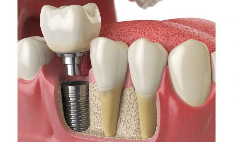 ایمپلنت دندان جایگزین مناسب برای دندان های از دست رفته | تکنا