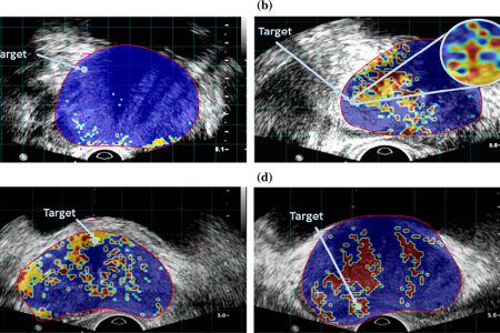 ابداع نوع جدیدی از سونوگرافی با هدف تشخیص زودهنگام سرطان پروستات