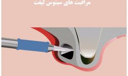 بررسی مهمترین مراقبتهای بعد از سینوس لیفت