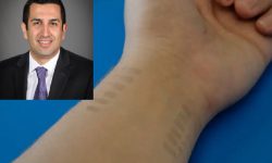 اندازه گیری مداوم فشار خون با کمک خالکوبی های ساخته شده از گرافین