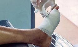 استفاده از شیره درخت برای درمان زخم های دیابتی