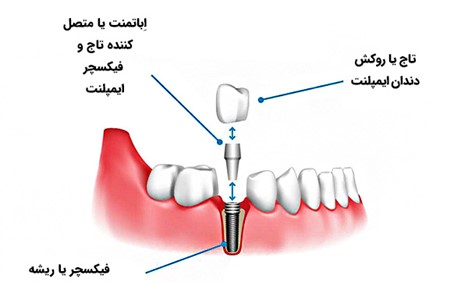 جزئیات ایمپلنت