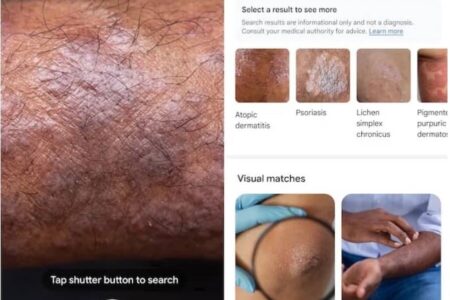با گوگل لنز می توانید بیماری پوستی را شناسایی کنید