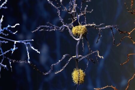 محققان با کالبد شکافی مغز مبتلایان به آلزایمر یافته‌های جدیدی را کشف کردند