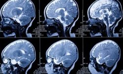 دستگاه جدید تشخیص زودهنگام گلیوبلاستوما با استفاده از فناوری نانویی کار می‌کند