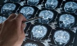 پیشرفت چشمگیر در تشخیص زودهنگام بیماری آلزایمر با استفاده از هوش مصنوعی