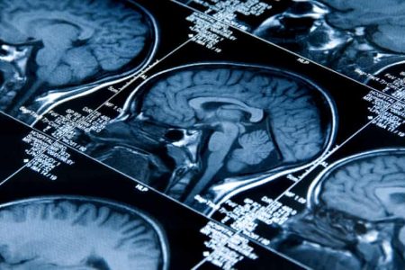 کشف الگوهای متفاوت اختلالات مغزی در افسردگی جوانان