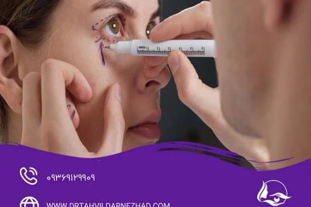 هزینه بلفاروپلاستی پلک بالا و پایین چقدر است؟ + بررسی عوامل موثر بر هزینه