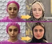 هزینه تزریق چربی