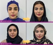 تزریق چربی Biofat چیست؟