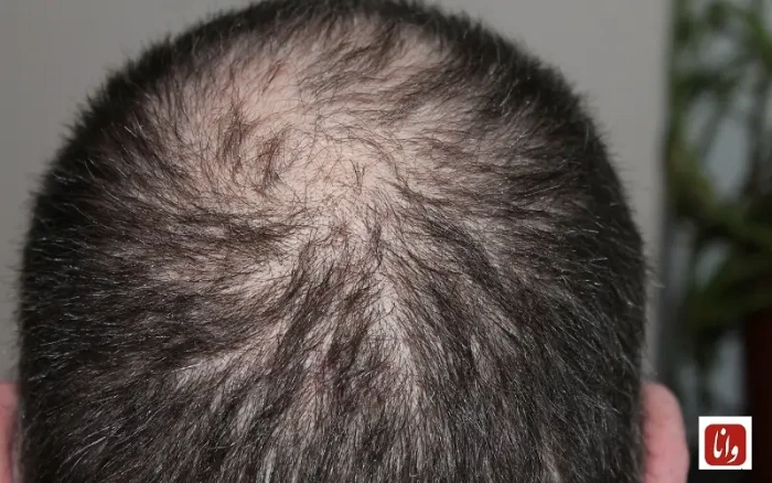 از علم تا زیبایی؛ روایت نو از آینده کاشت مو